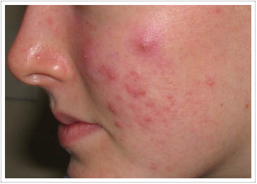 acne in woman