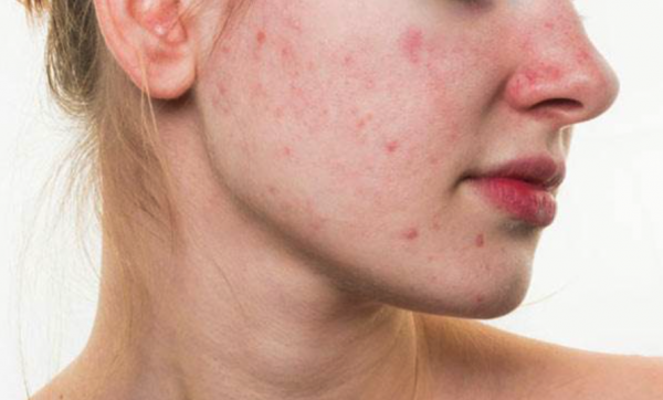 girls-cystic-acne-during-period-you-ve-got-to-read-this