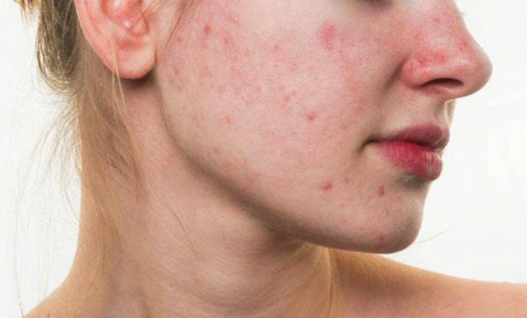 pregnancy-acne-treatments-and-home-remedies